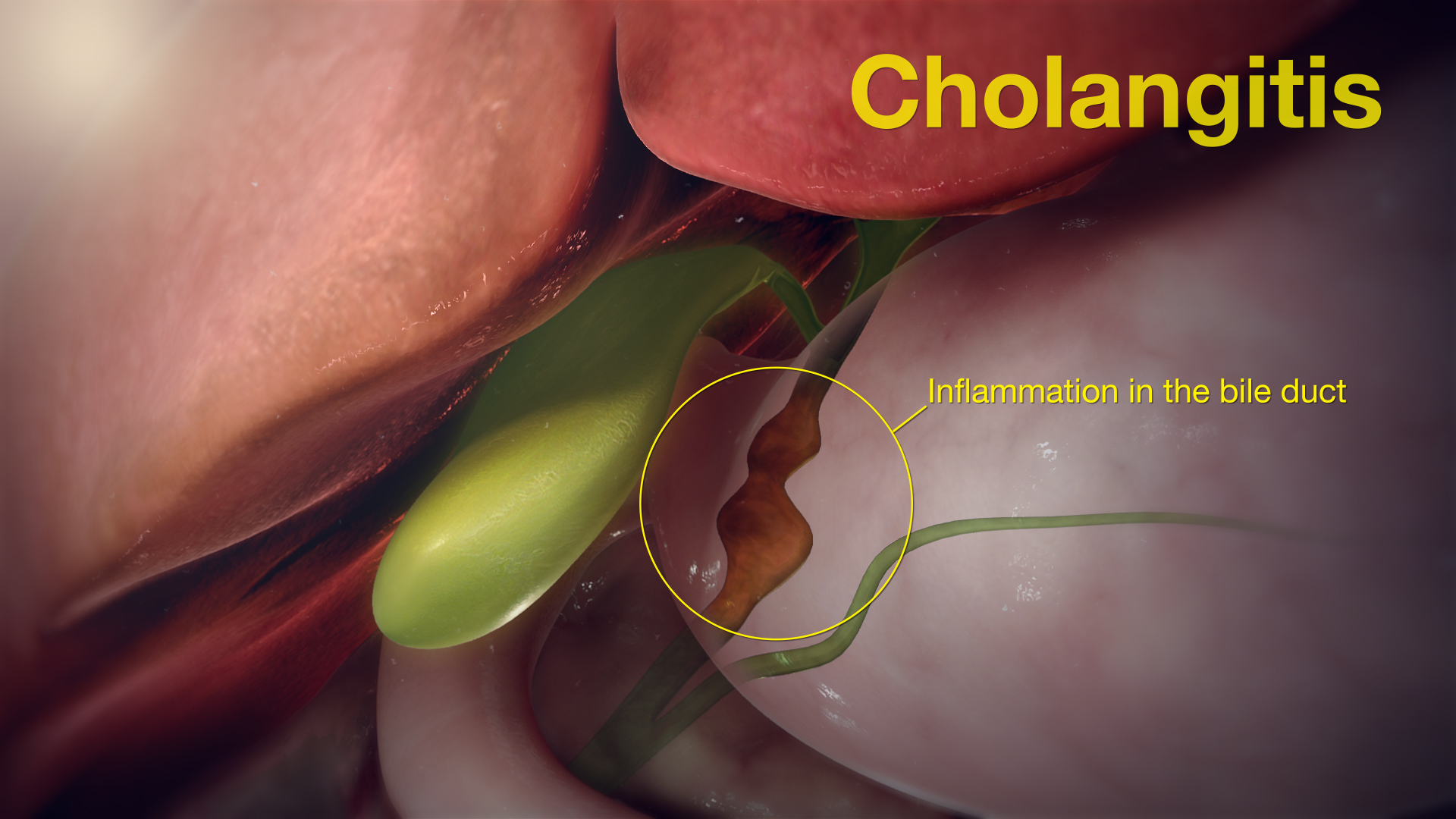 التهاب القنوات الصفراوية الصاعد (Cholangitis): حالة طبية طارئة يجب معرفتها